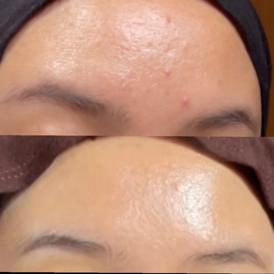 Acne Protect-Tea Spot Treatment imgfdn-1f537cfe-9d25-496d-84f5-272e5a2c6ed4