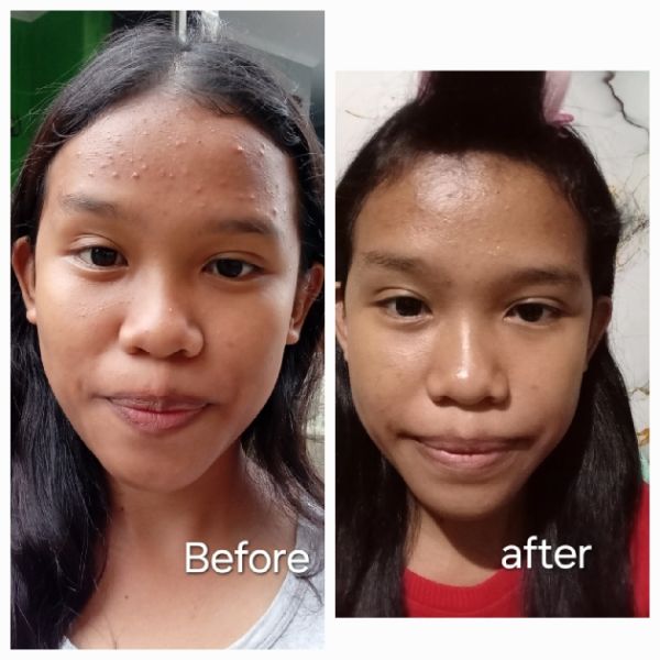 Centella Asiatica Acne Clear Hydrating & Calming Toner imgfdn-abb9ac66-eda5-481a-88bf-fde058b09575