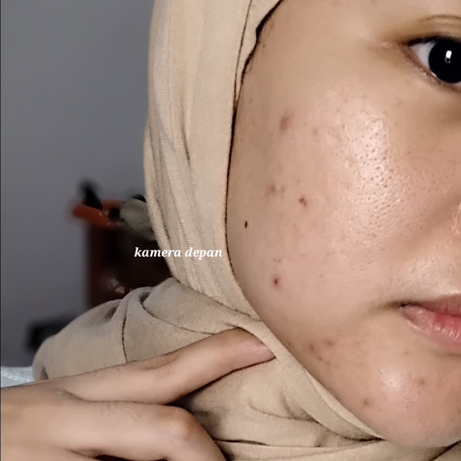 Acne Protect-Tea Spot Treatment imgfdn-1c4682fc-0219-4e80-ad29-79cbe116588e