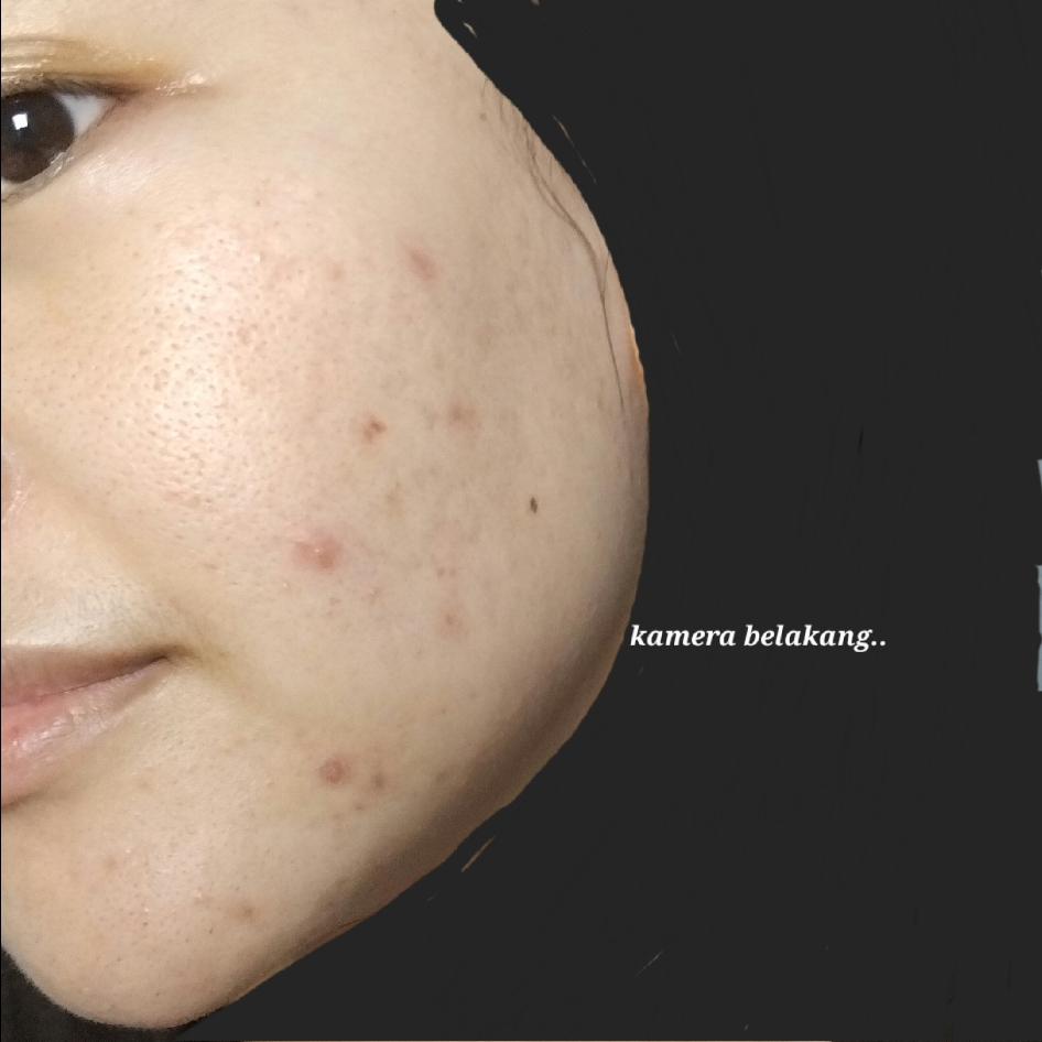 Acne Protect-Tea Spot Treatment imgfdn-90af0187-6bc9-4729-8923-cec1a4bb4272