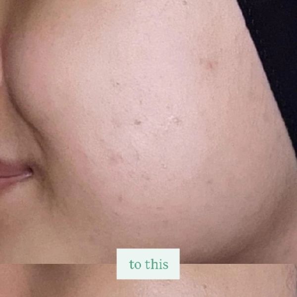 Centella Asiatica Acne Clear Hydrating & Calming Toner imgfdn-39a3063e-c94a-4681-83bf-7d1ead8ba82e